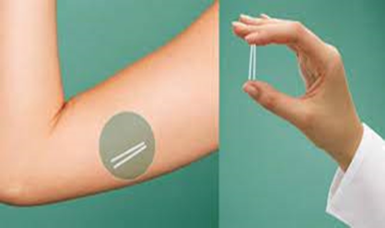 Están disponibles en La Rioja anticonceptivo subdérmico para jóvenes y adolescentes