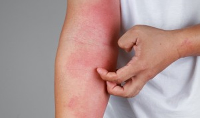 Dermatitis Atópica: 6 de cada 10 niños con esta patología tienen comorbilidades asociadas.
