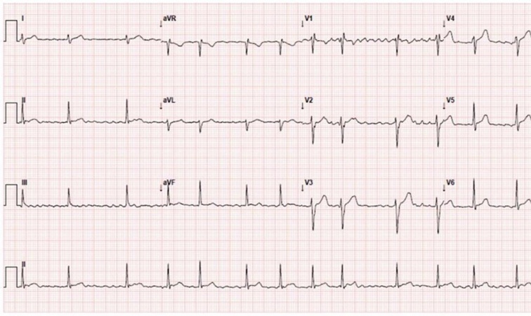 La fibrilación auricular aumenta el riesgo de ACV según estudio desarrollado por la FAC